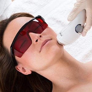 tratamentos a laser acne